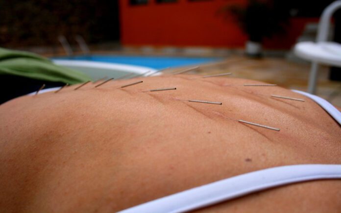 Can Acupuncture Help With Back Pain? 